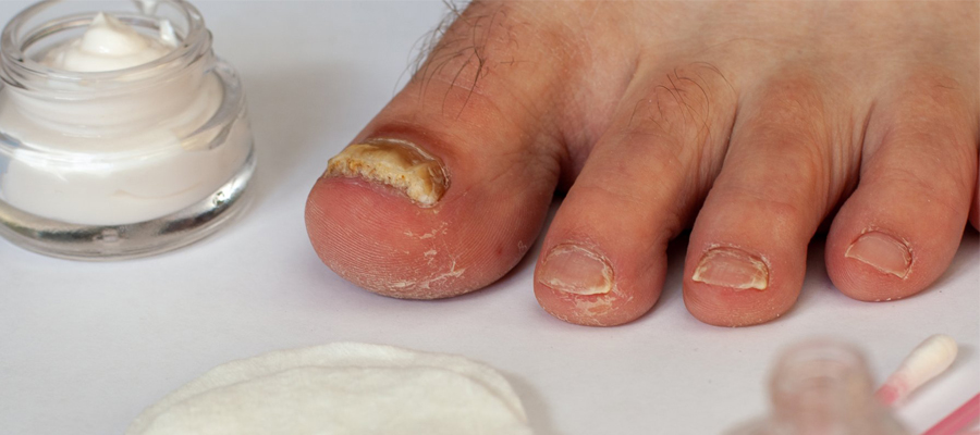 psoriasis des ongles